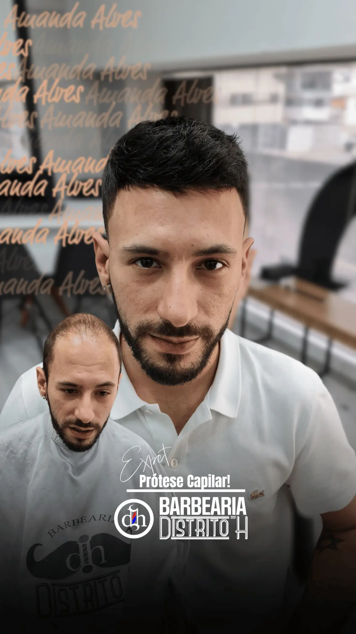 Resultado de Prótese Capilar